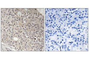Immunohistochemistry analysis of paraffin-embedded human prostate carcinoma tissue using AMOTL1 antibody. (AMOTL1 anticorps  (Internal Region))