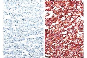 Paraffin embedded AIDS-associated Burkitt lymphoma tissue array was stained with anti-CXCR5 (right) and Rat IgG2b-UNLB (Rat IgG2b isotype control (Cy5))