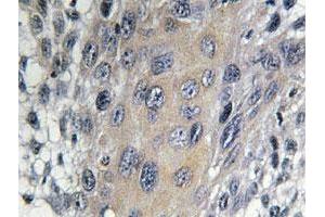 Immunohistochemical analysis of paraffin-embedded human cervix cancer tissue using COPZ1 polyclonal antibody . (COPZ1 anticorps)