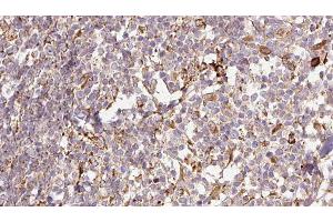 ABIN6276757 at 1/100 staining Human Melanoma tissue by IHC-P.