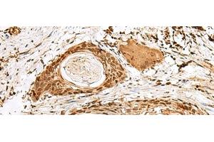 Immunohistochemistry of paraffin-embedded Human esophagus cancer tissue using SNAPC1 Polyclonal Antibody at dilution of 1:40(x200) (SNAPC1 anticorps)