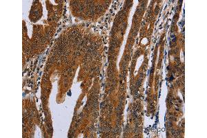 Immunohistochemistry of Human gastric cancer using GH2 Polyclonal Antibody at dilution of 1:60 (Growth Hormone 2 anticorps)
