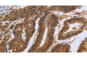 Immunohistochemistry of paraffin-embedded Human colon cancer using DUSP8 Polyclonal Antibody at dilution of 1:30 (DUSP8 anticorps)
