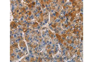 Immunohistochemistry of Human thyroid cancer using CST4 Polyclonal Antibody at dilution of 1:60 (CST4 anticorps)