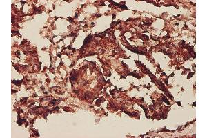 Immunoperoxidase of monoclonal antibody to PHB on formalin-fixed paraffin-embedded human colon adenocarcinoma.