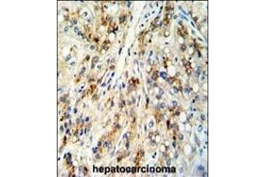 Formalin-fixed and paraffin-embedded human hepatocarcinoma reacted with CECR5 Antibody (Center), which was peroxidase-conjugated to the secondary antibody, followed by DAB staining.