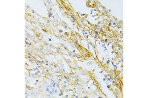 Immunohistochemistry of paraffin-embedded human lung cancer using TGFBI antibody. (TGFBI anticorps  (AA 481-683))
