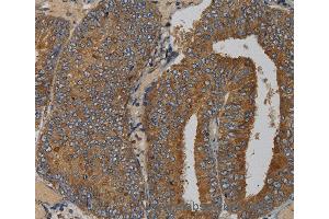 Immunohistochemistry of Human liver cancer using MAS1 Polyclonal Antibody at dilution of 1:50