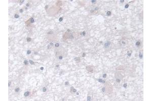 Detection of CCT2 in Human Glioma Tissue using Polyclonal Antibody to Chaperonin Containing TCP1, Subunit 2 (CCT2)