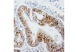 Anti-CCR5 antibody, IHC(P) IHC(P): Human Rectal Cancer Tissue
