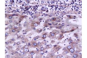 Formalin-fixed and paraffin embedded human liver carcinoma labeled with Anti-MRP2 Polyclonal Antibody, Unconjugated (ABIN737541) at 1:200 followed by conjugation to the secondary antibody and DAB staining.