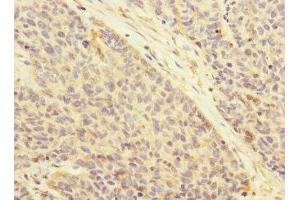 Immunohistochemistry of paraffin-embedded human ovarian cancer using ABIN7145065 at dilution of 1:100 (Attractin anticorps  (AA 84-350))