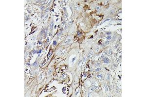 Immunohistochemistry of paraffin-embedded human esophageal cancer using PDGFRB Rabbit pAb (ABIN6134579, ABIN6145372 and ABIN7101437) at dilution of 1:100 (40x lens). (PDGFRB anticorps)