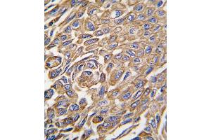 Formalin-fixed and paraffin-embedded human lung carcinoma tissue reacted with ALDH3A1 antibody (Center), which was peroxidase-conjugated to the secondary antibody, followed by DAB staining. (ALDH3A1 anticorps  (AA 254-284))