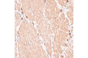 Immunohistochemistry of paraffin-embedded human gastric cancer using  antibody (ABIN7265735) at dilution of 1:100 (40x lens).