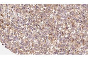 ABIN6279790 at 1/100 staining Human Melanoma tissue by IHC-P. (FRZB anticorps  (C-Term))