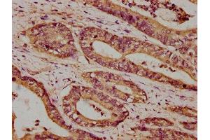 IHC image of ABIN7163520 diluted at 1:100 and staining in paraffin-embedded human colon cancer performed on a Leica BondTM system.