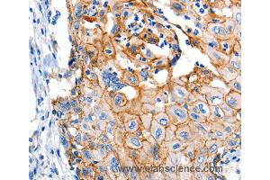Immunohistochemistry of Human cervical cancer using CLDN1 Polyclonal Antibody at dilution of 1:150 (Claudin 1 anticorps)