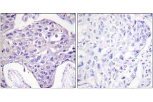 Immunohistochemistry analysis of paraffin-embedded human breast carcinoma tissue, using FOXO1/3/4-pan (Ab-24/32) Antibody. (FOXO1 anticorps  (AA 15-64))
