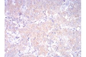 Immunohistochemical analysis of paraffin-embedded ovarian cancertissues using LDLR mouse mAb with DAB staining.