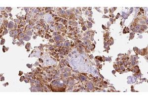 ABIN6274621 at 1/100 staining Human Melanoma tissue by IHC-P.