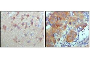 Immunohistochemical analysis of paraffin-embedded human cerebra (left) and breast carcinoma tissue (right),showing cytoplasmic and membrane location with DAB staining using ERBB3 antibody. (ERBB3 anticorps  (AA 1175-1275))