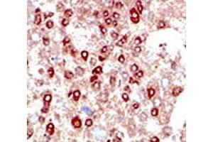 IHC testing of human hepatocarcinoma stained with SUMO2/3 antibody. (SUMO2/3 anticorps  (AA 49-81))