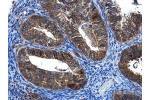 IHC-P Image FGD4 antibody [N1N3] detects FGD4 protein at cytoplasm in human endometrial cancer by immunohistochemical analysis. (FGD4 anticorps)