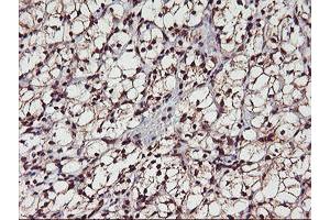 Immunohistochemical staining of paraffin-embedded Carcinoma of Human kidney tissue using anti-MGLL mouse monoclonal antibody. (MGLL anticorps)