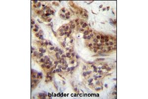 FOXA2 Antibody (Center ) (ABIN657130 and ABIN2846274) immunohistochemistry analysis in formalin fixed and paraffin embedded human bladder carcinoma followed by peroxidase conjugation of the secondary antibody and DAB staining. (FOXA2 anticorps  (AA 134-163))