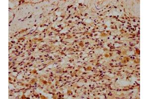IHC image of ABIN7150293 diluted at 1:300 and staining in paraffin-embedded human lung cancer performed on a Leica BondTM system. (REV1 anticorps  (AA 1035-1160))