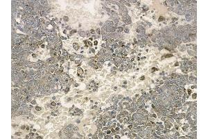 ABIN6259198 and ABIN6274317 at 1/100 staining human melanoma by IHC-P. (SSBP1 anticorps  (Internal Region))