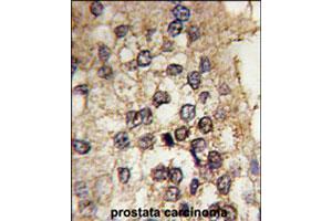 Formalin-fixed and paraffin-embedded human prostate carcinoma tissue reacted with CLOCK polyclonal antibody  , which was peroxidase-conjugated to the secondary antibody, followed by DAB staining. (CLOCK anticorps  (Internal Region))