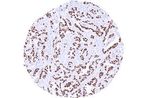 Invasive breast cancer of no special type NST with intense nuclear TRPS1 positivity Dilution 1:600