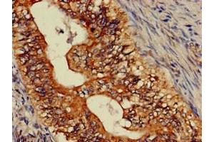 Immunohistochemistry of paraffin-embedded human colon cancer using ABIN7144771 at dilution of 1:100 (Astrotactin 2 anticorps  (AA 108-272))