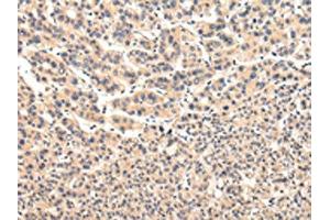 The image on the left is immunohistochemistry of paraffin-embedded Human liver cancer tissue using ABIN7131583(VPS37A Antibody) at dilution 1/20, on the right is treated with fusion protein.