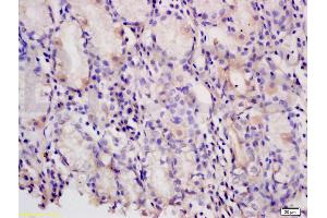 Formalin-fixed and paraffin embedded human gastric carcinoma tissue labeled with Anti-PAF Polyclonal Antibody, Unconjugated (ABIN737931) at 1:200 followed by conjugation to the secondary antibody and DAB staining