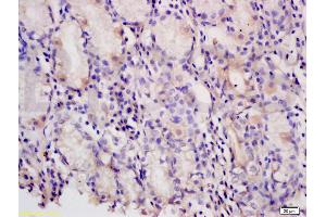 Formalin-fixed and paraffin embedded human gastric carcinoma tissue labeled with Anti-PAF Polyclonal Antibody, Unconjugated (ABIN737931) at 1:200 followed by conjugation to the secondary antibody and DAB staining (KIAA0101 anticorps)