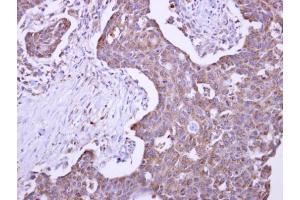 IHC-P Image Malectin antibody detects KIAA0152 protein at cytosol on human colon carcinoma by immunohistochemical analysis. (Malectin anticorps)