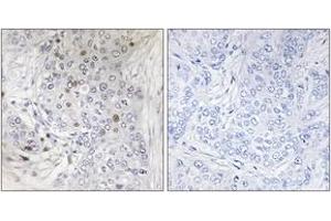 Immunohistochemistry analysis of paraffin-embedded human breast carcinoma tissue, using MAFF Antibody. (MafF anticorps  (AA 51-100))