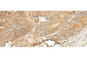 Immunohistochemistry of paraffin-embedded Human colorectal cancer tissue using ADGRF5 Polyclonal Antibody at dilution of 1:40(x200) (G Protein-Coupled Receptor 116 anticorps)