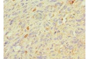 Immunohistochemistry of paraffin-embedded human melanoma using ABIN7154393 at dilution of 1:100 (Granulin anticorps  (AA 20-310))