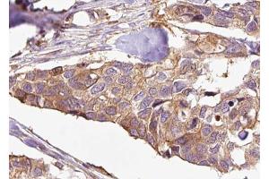ABIN6272998 at 1/100 staining Human breast cancer tissue by IHC-P.