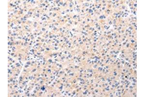 The image on the left is immunohistochemistry of paraffin-embedded Human liver cancer tissue using ABIN7190022(BSN Antibody) at dilution 1/20, on the right is treated with synthetic peptide. (Bassoon anticorps)