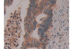 Detection of CYCS in Human Colorectal cancer Tissue using Polyclonal Antibody to Cytochrome C (CYCS)