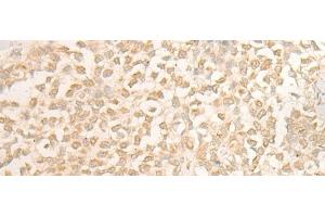 Immunohistochemistry of paraffin-embedded Human ovarian cancer tissue using DUSP27 Polyclonal Antibody at dilution of 1:50(x200) (DUSP27/STYXL2 anticorps)