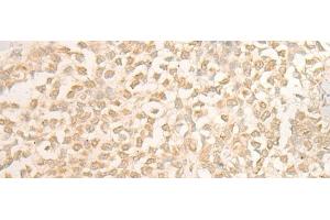 Immunohistochemistry of paraffin-embedded Human ovarian cancer tissue using DUSP27 Polyclonal Antibody at dilution of 1:50(x200) (DUSP27/STYXL2 anticorps)