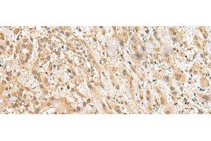 Immunohistochemistry of paraffin-embedded Human liver cancer tissue using NUDT12 Polyclonal Antibody at dilution of 1:25(x200) (NUDT12 anticorps)