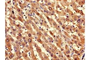 Immunohistochemistry of paraffin-embedded human liver cancer using ABIN7143224 at dilution of 1:100