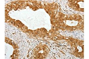 The image on the left is immunohistochemistry of paraffin-embedded Human cervical cancer tissue using ABIN7131317(TEKT1 Antibody) at dilution 1/30, on the right is treated with fusion protein. (TEKT1 anticorps)